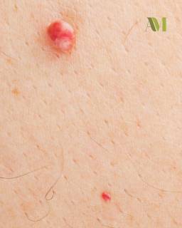 Elimina puntos rubí y verrugas de forma rápida y segura.
Con nuestro Láser 980nm tratamos lesiones cutáneas tanto faciales como corporales, de manera precisa, mínimamente invasiva y con excelente resultado estético.
✔️ Procedimiento rápido
✔️ Alta precisión
✔️ Recuperación rápida
Luce una piel más uniforme en cualquier zona
Agenda tu valoración.
#Láser980nm #PuntosRubí #Verrugas #amesteticavanzada #pielsana