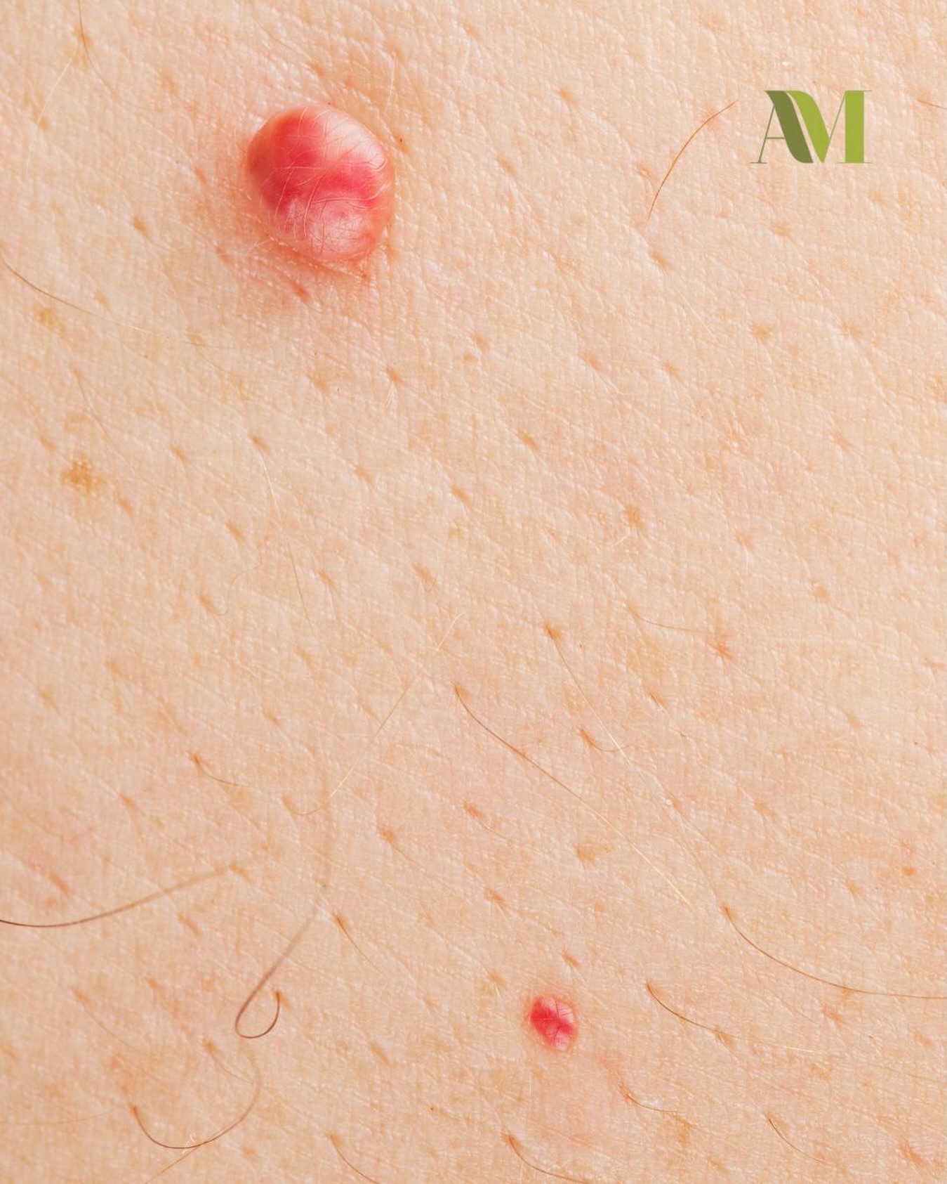 Elimina puntos rubí y verrugas de forma rápida y segura.
Con nuestro Láser 980nm tratamos lesiones cutáneas tanto faciales como corporales, de manera precisa, mínimamente invasiva y con excelente resultado estético.
✔️ Procedimiento rápido
✔️ Alta precisión
✔️ Recuperación rápida
Luce una piel más uniforme en cualquier zona
Agenda tu valoración.
#Láser980nm #PuntosRubí #Verrugas #amesteticavanzada #pielsana