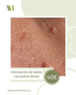 Despídete de las imperfecciones vasculares.
Con nuestro láser 980nm vascular tratamos de forma precisa y segura:
⚫️ Arañas vasculares
⚫️ Puntos rubí
⚫️ Verrugas
Tecnología avanzada que actúa directamente sobre la lesión, con procedimiento rápido y mínima recuperación.
Resultados visibles, piel más uniforme y mayor confianza.
#amesteticavanzada #verrugaseliminación #centroestetico #málaga #