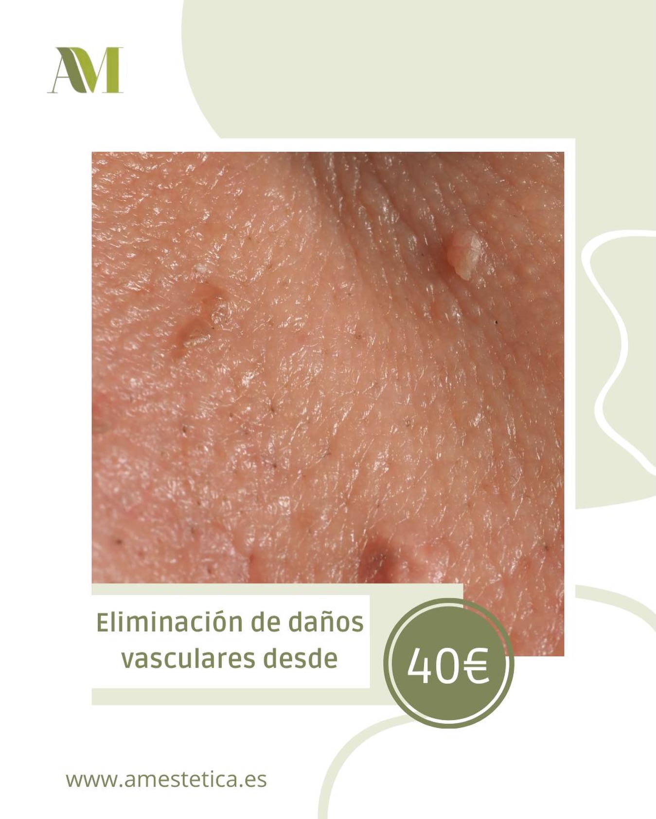 Despídete de las imperfecciones vasculares.
Con nuestro láser 980nm vascular tratamos de forma precisa y segura:
⚫️ Arañas vasculares
⚫️ Puntos rubí
⚫️ Verrugas
Tecnología avanzada que actúa directamente sobre la lesión, con procedimiento rápido y mínima recuperación.
Resultados visibles, piel más uniforme y mayor confianza.
#amesteticavanzada #verrugaseliminación #centroestetico #málaga #