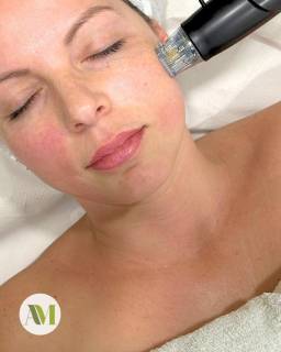 ¿Lista para renovar tu piel?
La radiofrecuencia fraccionada es el tratamiento estrella para rejuvenecer, reafirmar y mejorar la textura de tu piel sin cirugía.
💎 ¿Qué consigue?
✔️ Estimula la producción natural de colágeno
✔️ Reduce arrugas y líneas de expresión
✔️ Mejora cicatrices y marcas de acné
✔️ Minimiza poros
✔️ Aporta firmeza y luminosidad
Es ideal si buscas un efecto lifting progresivo y natural, con resultados visibles desde las primeras sesiones
Tu piel puede verse más firme, lisa y rejuvenecida… y lo mejor: ¡con un procedimiento seguro y mínimamente invasivo!
#radiofrecuenciafraccionada #arrugas #marcasdeacne #rejuvenecimiento #amesteticavanzada